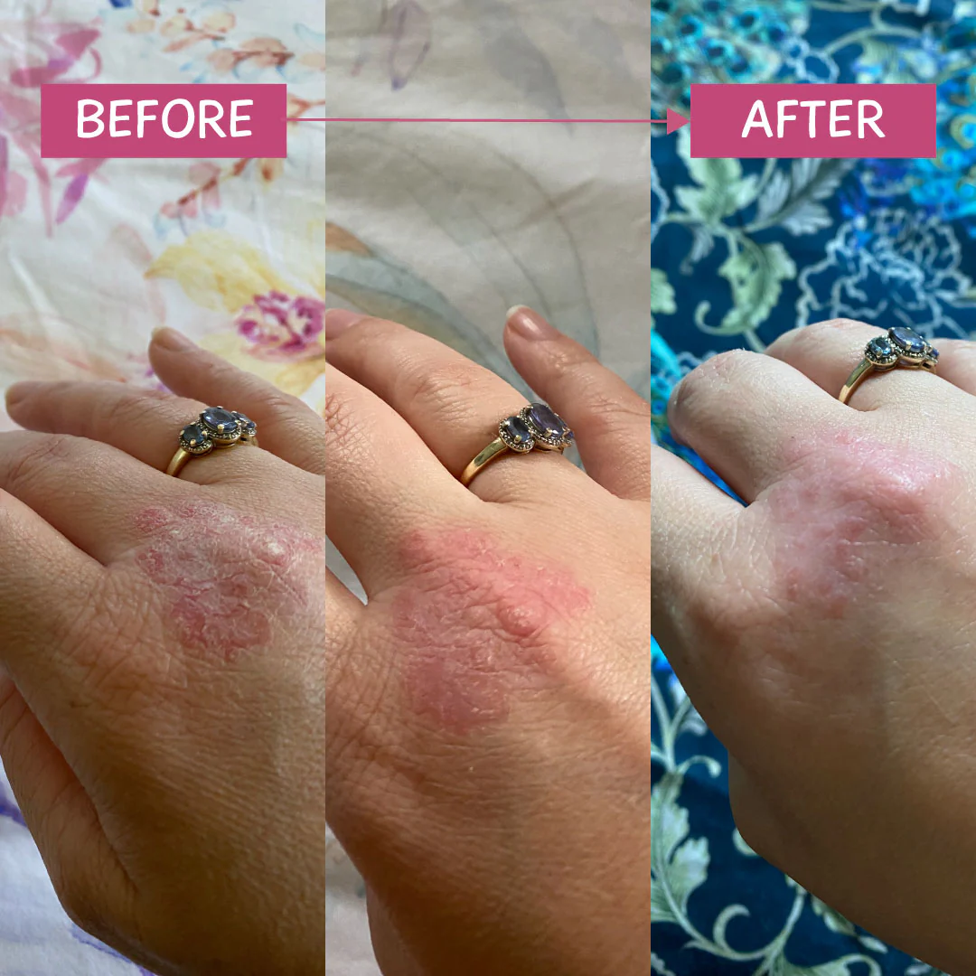 Pink Eczema Cream 100g - Image 4