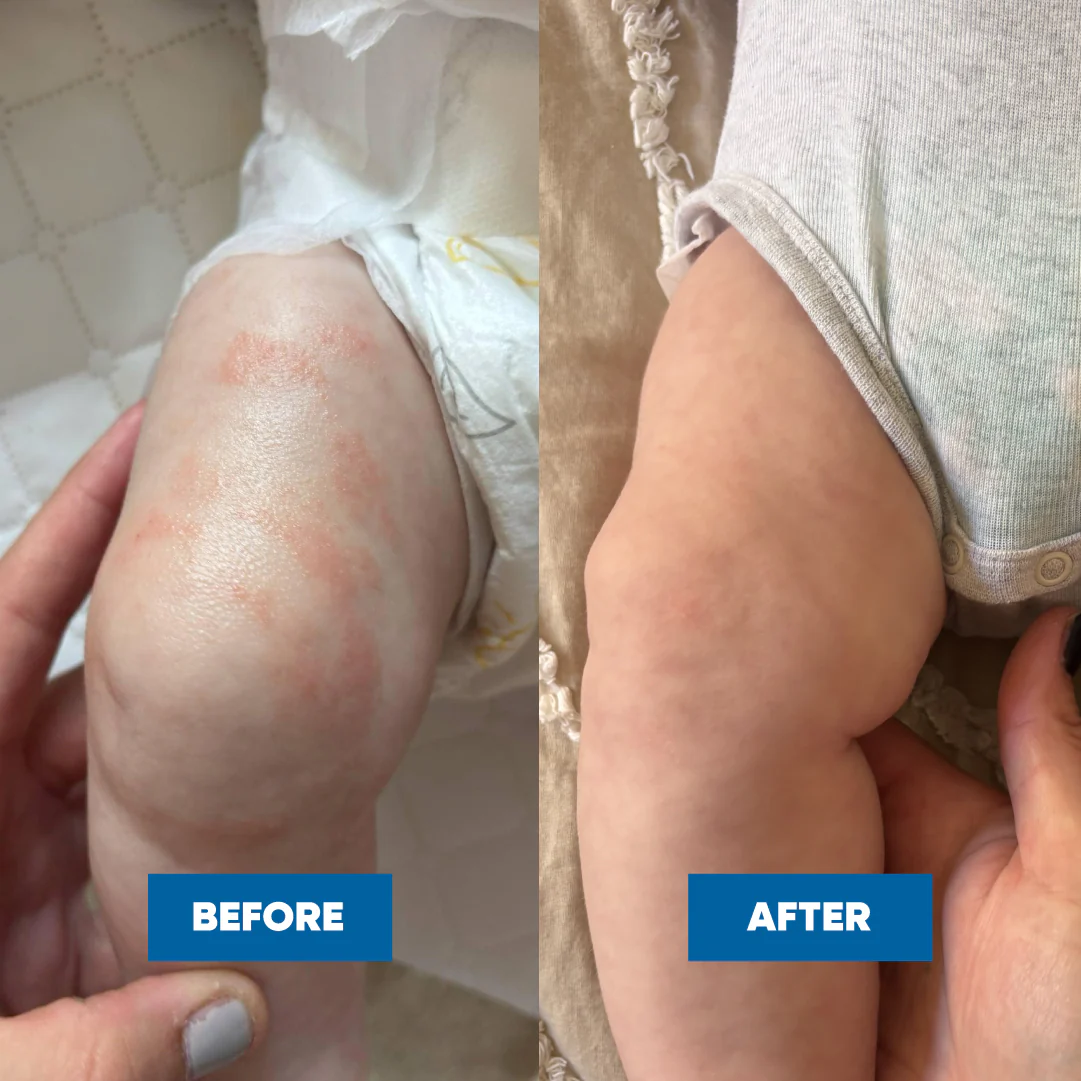 Pink Eczema Cream 100g - Image 6